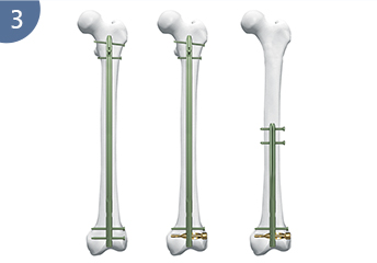 Expert R/Afn. Retrograde /Antegrade Femoral Nail