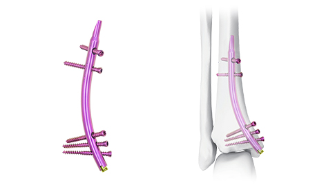Distal Tibial Nail: A Breakthrough in The Treatment of Distal Tibial Fractures