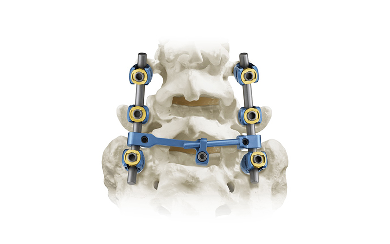 5.5-Spinal-Pedicle-Screw-System