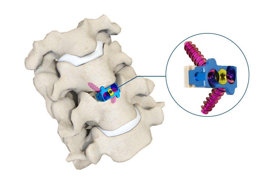 Anterior cervical discectomy with decompression and implant fusion (ACDF) 