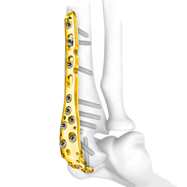 Olecranon Locking Plate
