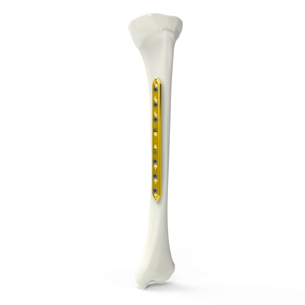 Tibia Locking Plate Narrow