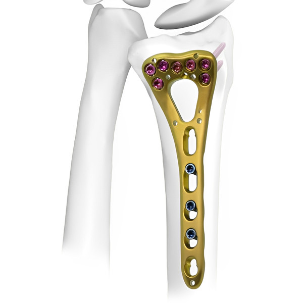 VA Distal Radius Locking Plate