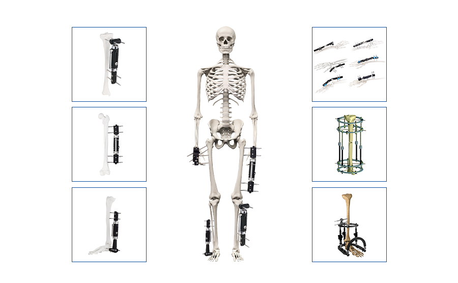 External Fixation Device External Fixator Leg External Fixator Ankle