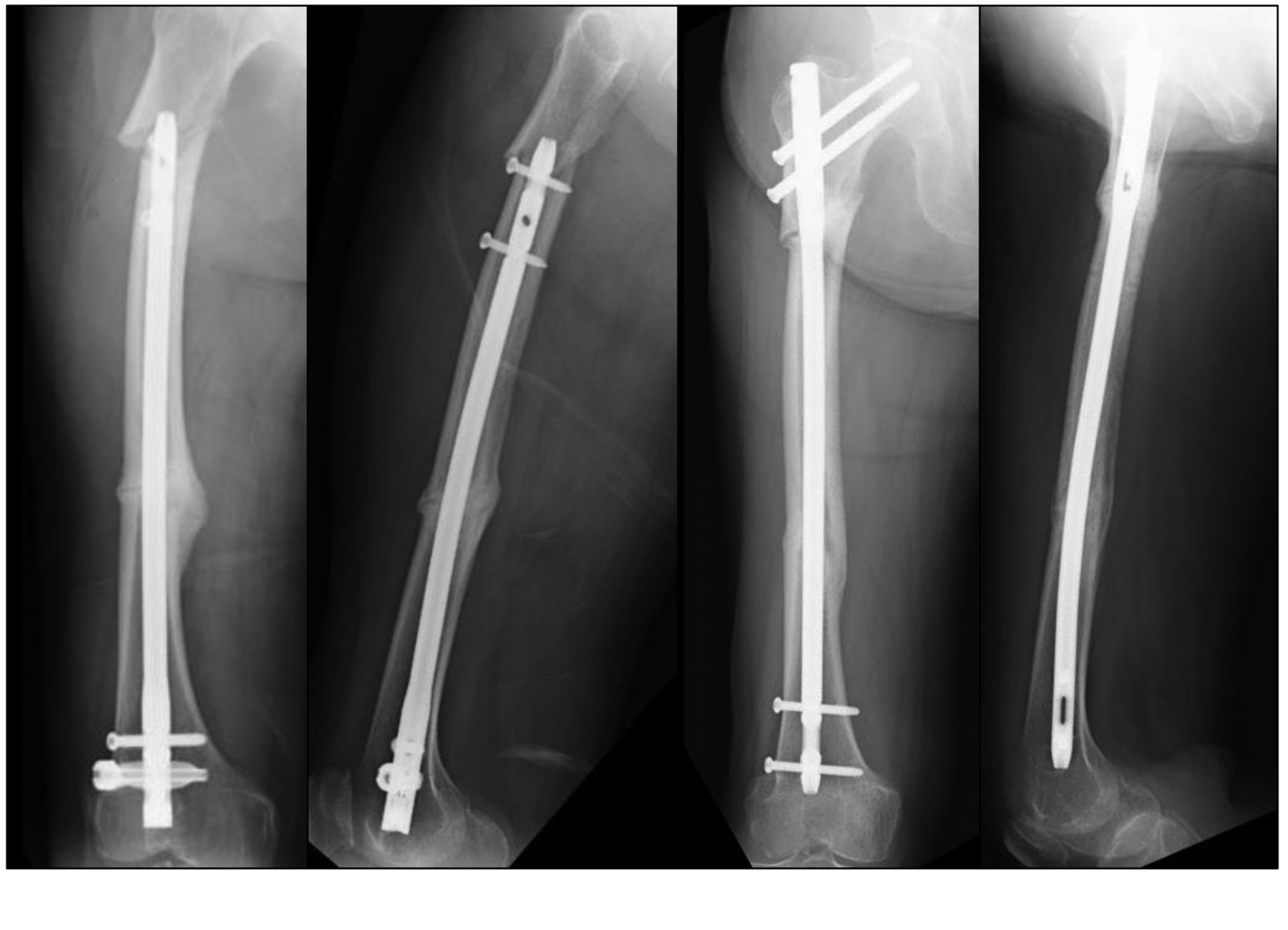 What are intramedullary nails?