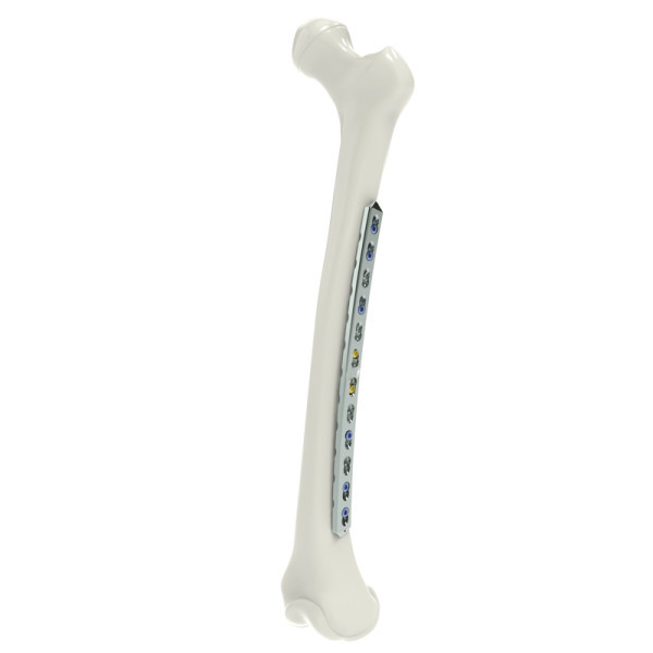 Curved Femur Locking Compression Plate(Broad)