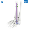 Hindfoot Fusion Ankle Nail