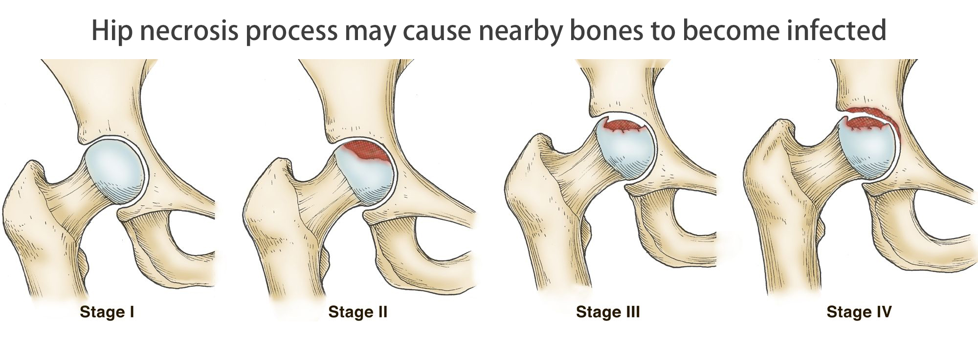 Hip necrosis process