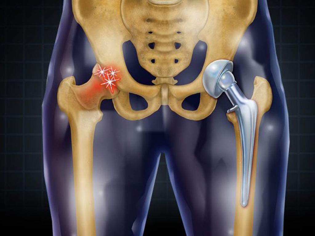 Scenarios for use of the femoral stem
