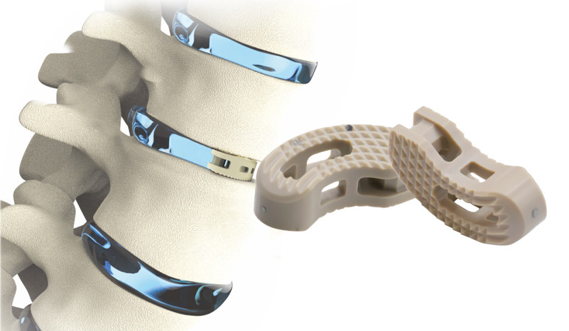 Lumbar Implants: A Comprehensive Guide