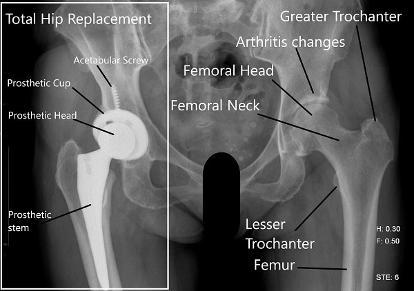 Where to use the femoral handle