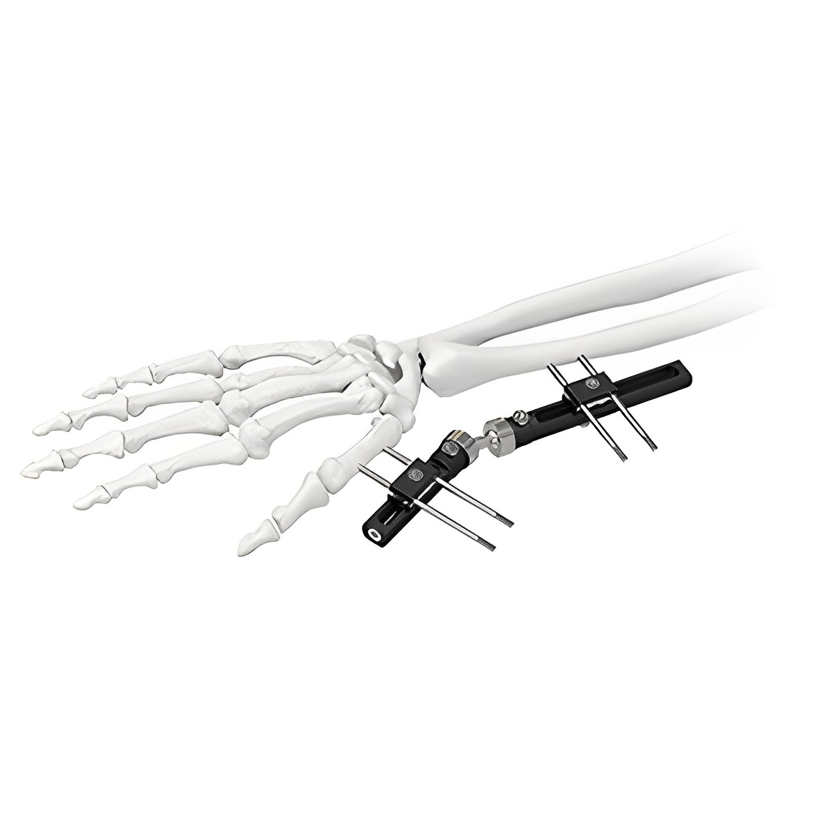 Wrist External Fixator