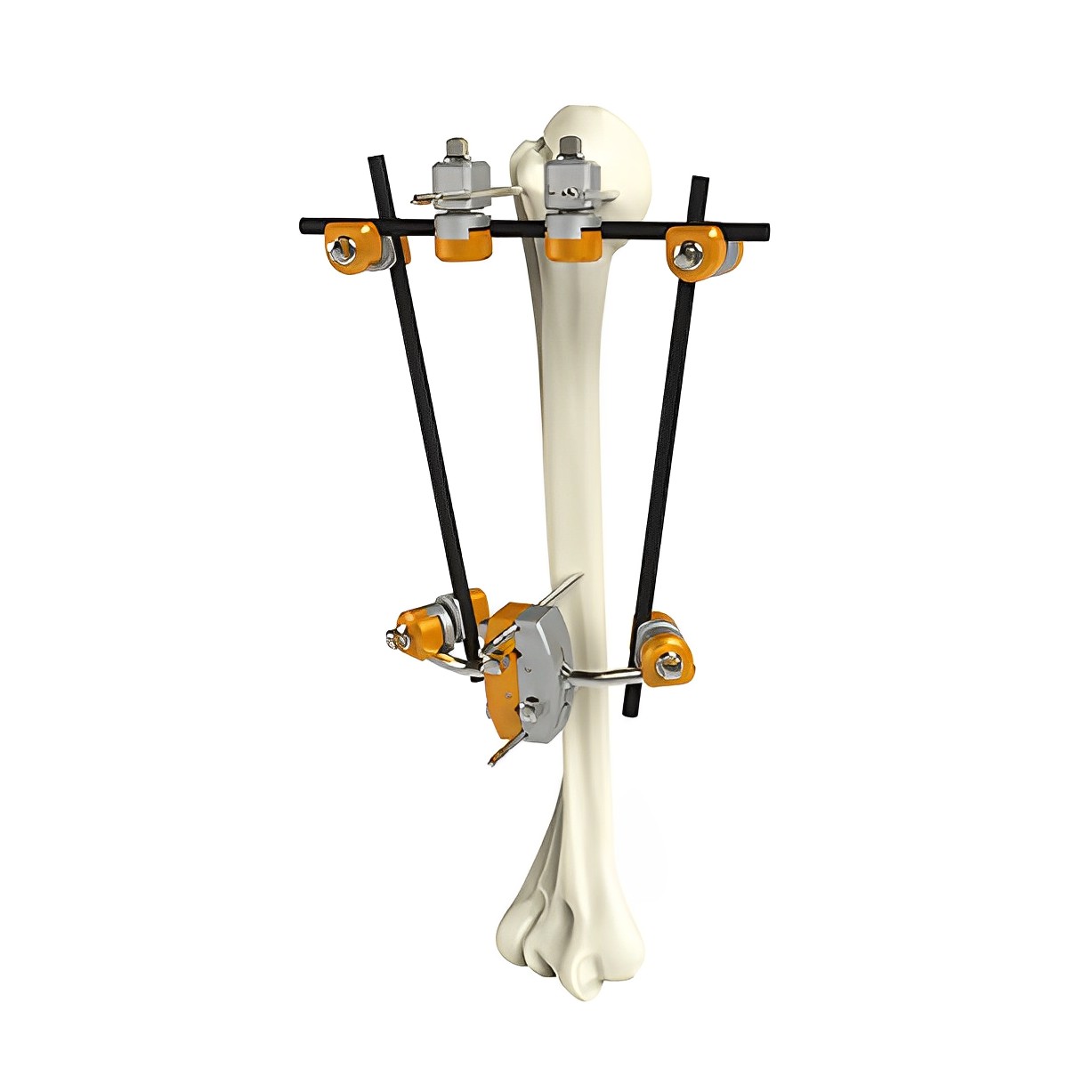 Small Fragment External Fixator