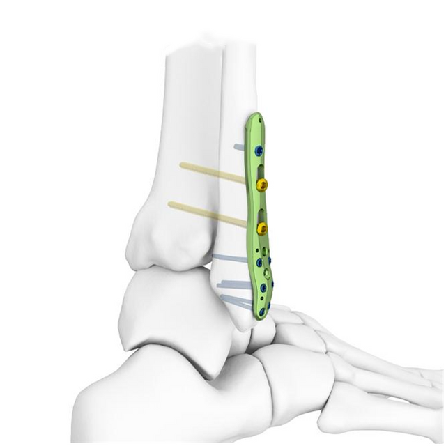 Distal Fibular Locking Plate