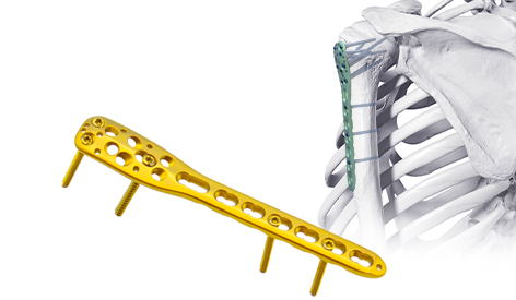 Technical Outline for Plate Fixation of Distal Humerus Fractures