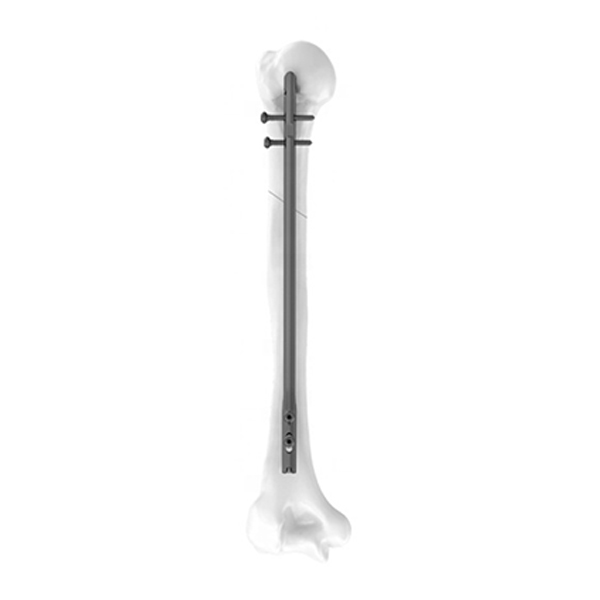Humeral Nail