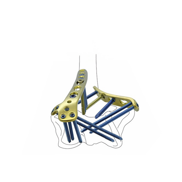 Distal Medial Humeral Locking Plate