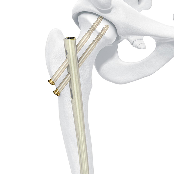Femur Nail
