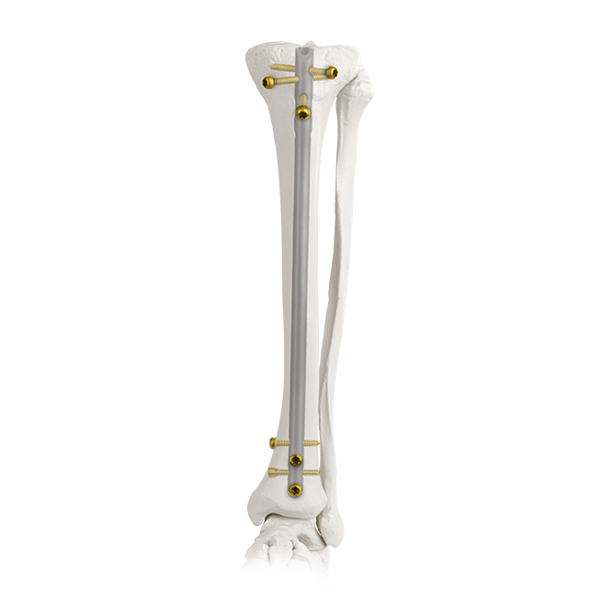 Tibial Nail