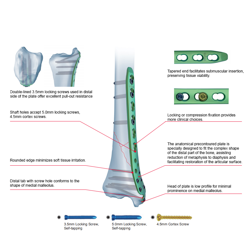 Proximal Lateral Tibial Locking Plate-II
