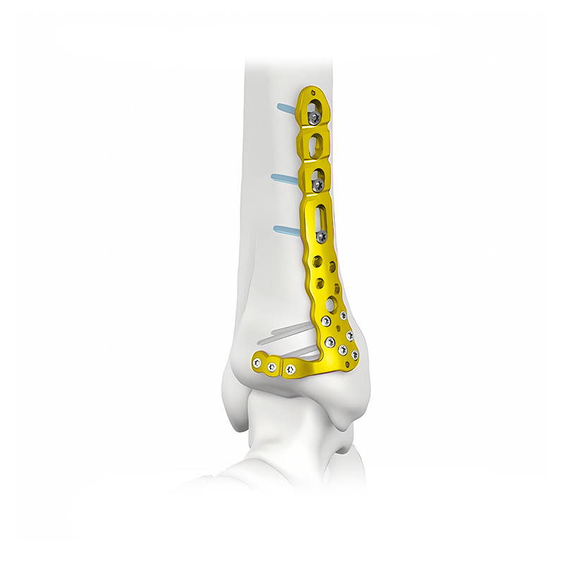 Proximal Lateral Tibial Locking Plate-II