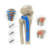 Proximal Lateral Tibial Locking Plate-II