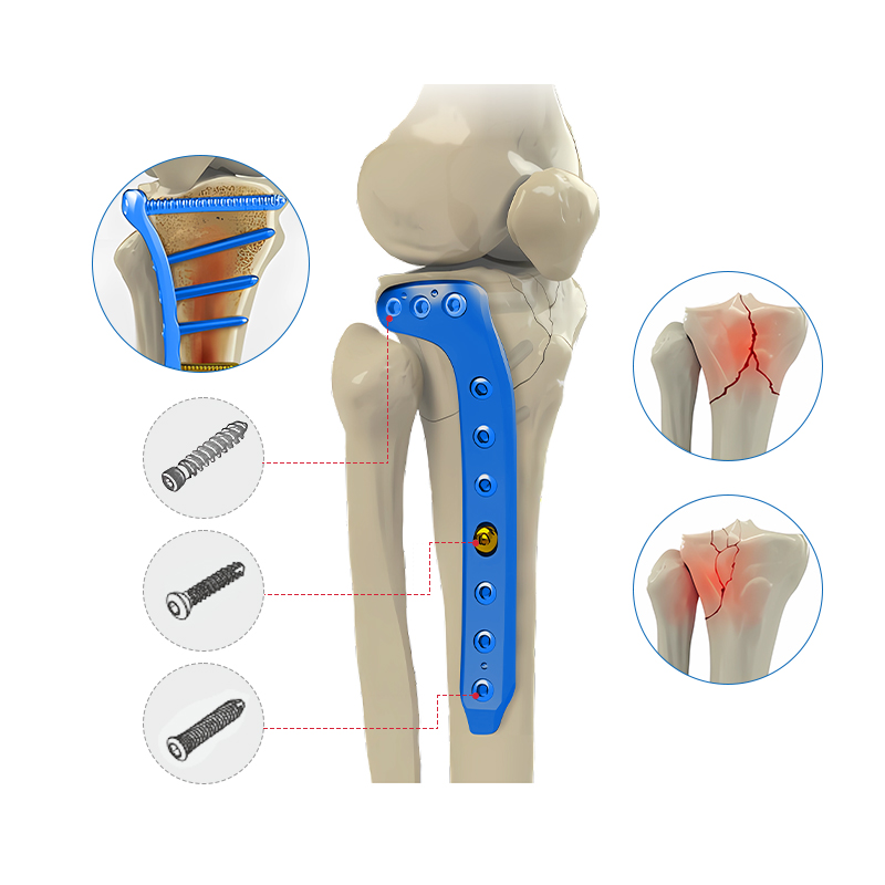 Proximal Lateral Tibial Locking Plate-II