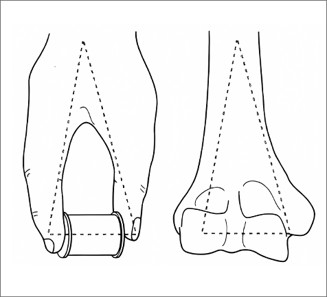 Humeral Locking Plate