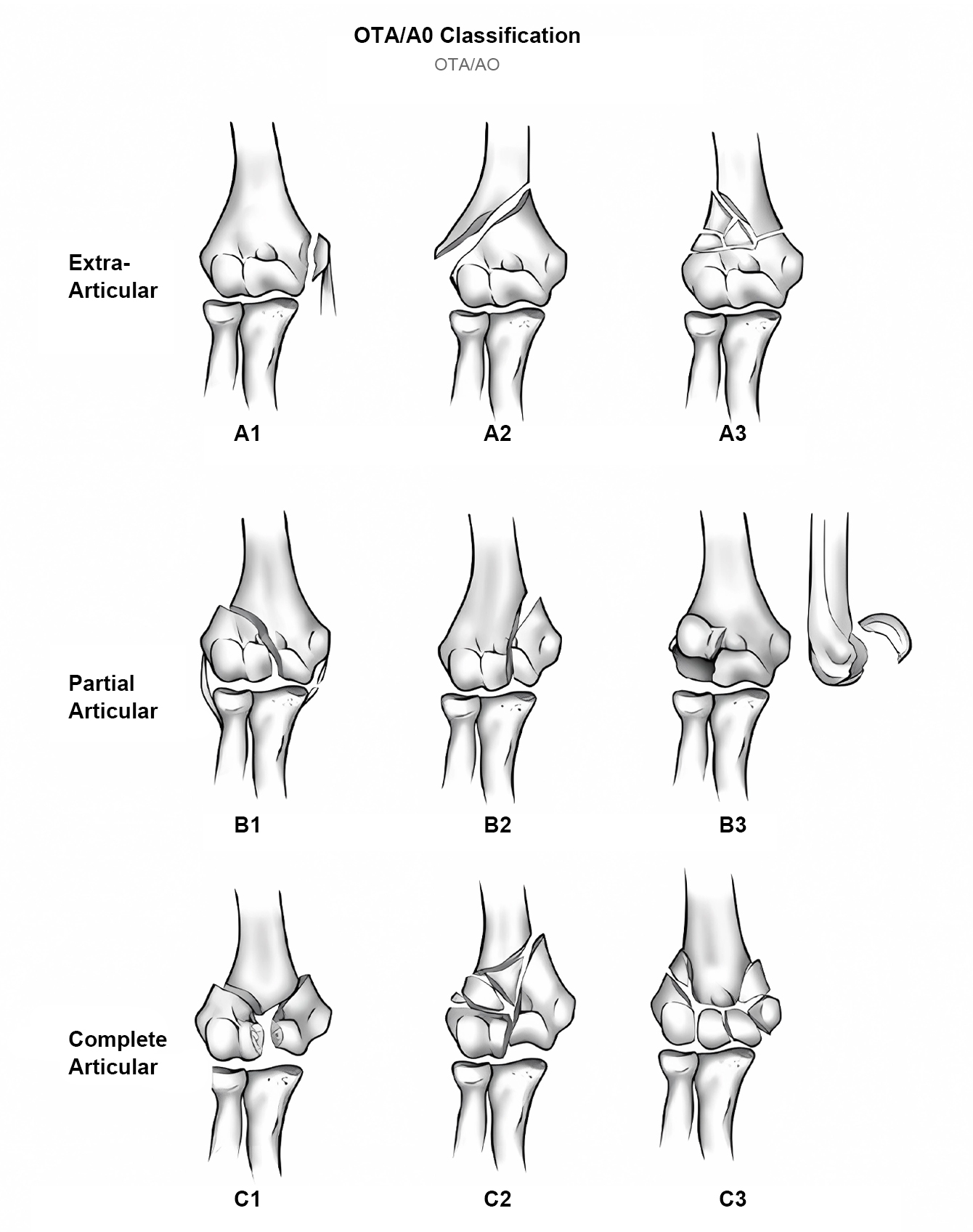 Humeral Locking Plate