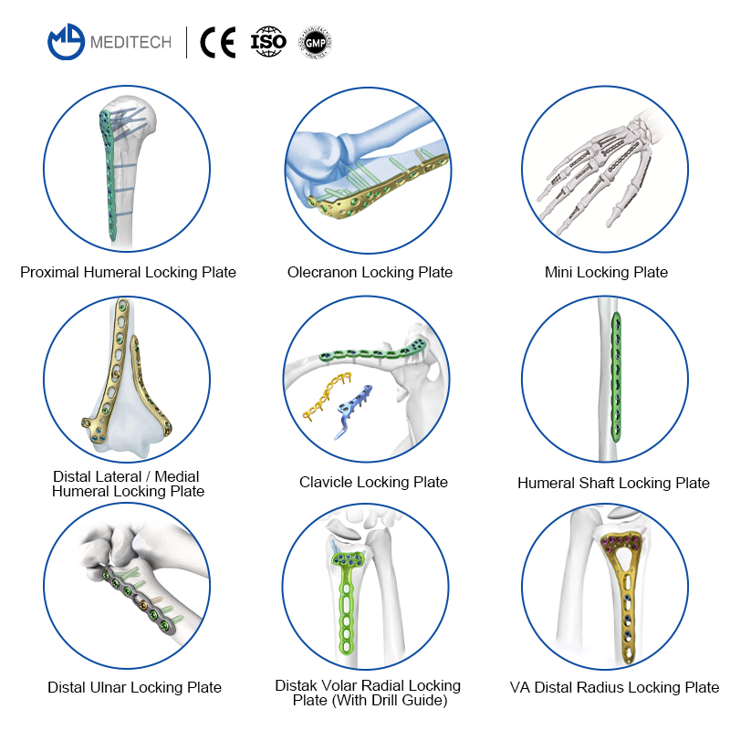 VA Distal Radius Locking Plate