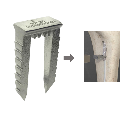 Ligament Staple