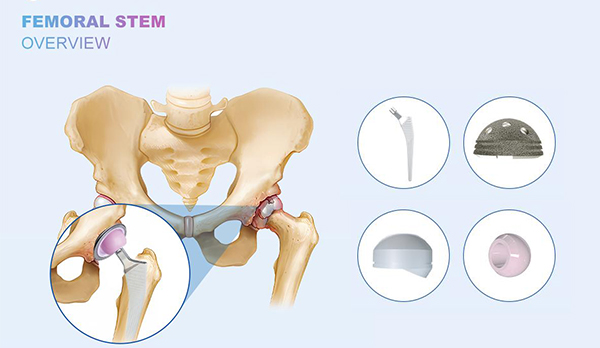 Comprehensive analysis of femoral Stem and top 5 femoral Stem brand merchants