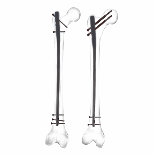 Expert Femoral Nail